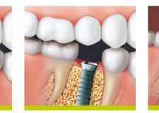 Implant Dentar Bucuresti